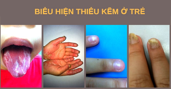 Triệu chứng thiếu kẽm ở trẻ